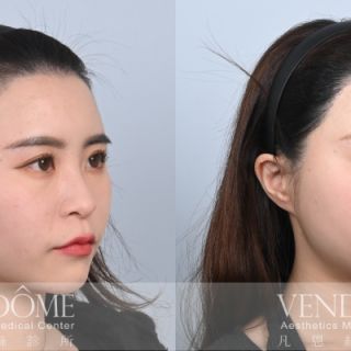 美型髮際線植髮不只是補毛，更能明顯提升臉部的立體感和年輕度。醫師會考量額頭比例、臉型輪廓以及整體氣質，設計出最適合的髮際線形狀，強調自然且具有美感。  適合追求精緻外觀、希望臉部輪廓更和諧的族群，彌補原本髮際線不對稱或線條不理想的缺陷。